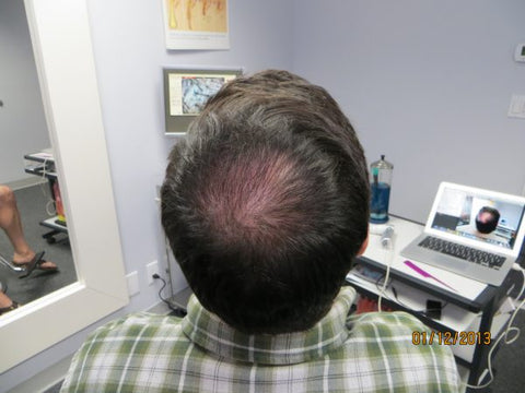 Men's Hair Regrowth Results FM2