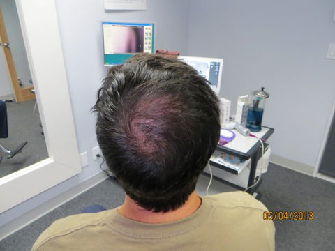 Men's Hair Regrowth Results FM1