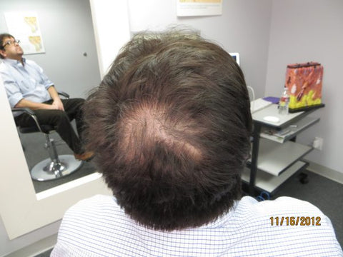 Men Hair Regrowth Results GC1