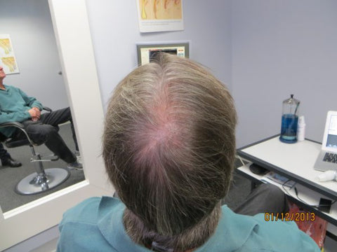 Men's Hair Regrowth Results KM2