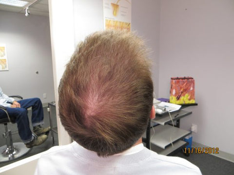 Men's Hair Regrowth Results MM1