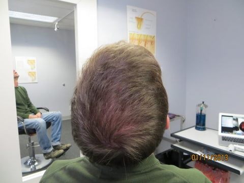 Men's Hair Regrowth Results MM2