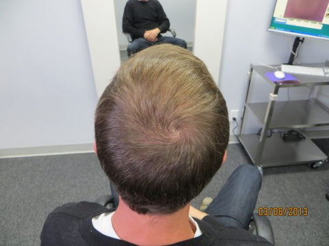 Men's Hair Regrowth Results MM3