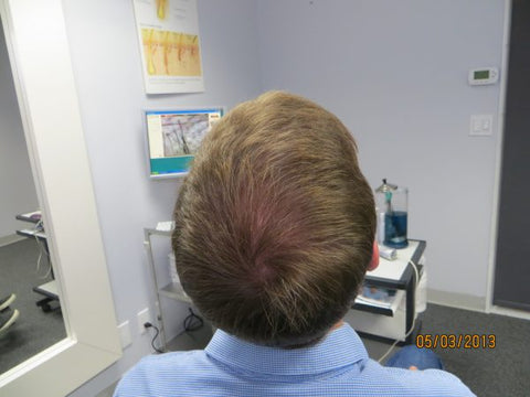 Men's Hair Regrowth Results MM4