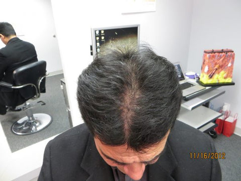 Men's Hair Regrowth Results XM1