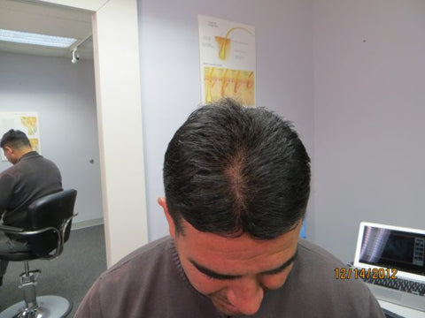 Men's Hair Regrowth Results XM2