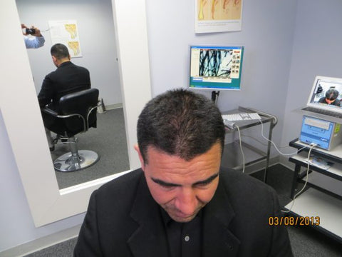 Men's Hair Regrowth Results XM3