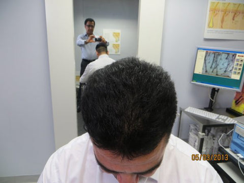 Men's Hair Regrowth Results XM4