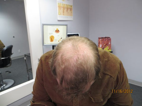 Men Hair Regrowth Results ZD1