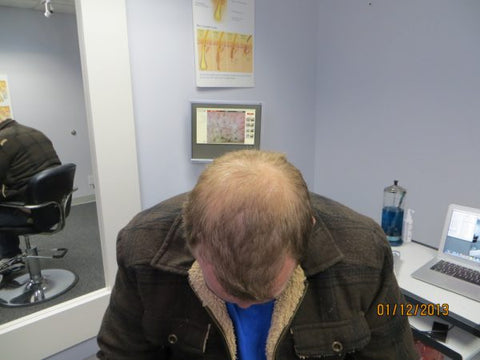 Men Hair Regrowth Results ZD2