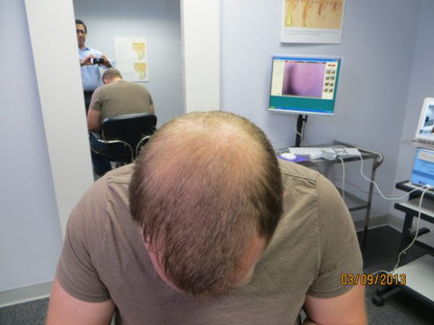 Men Hair Regrowth Results ZD3