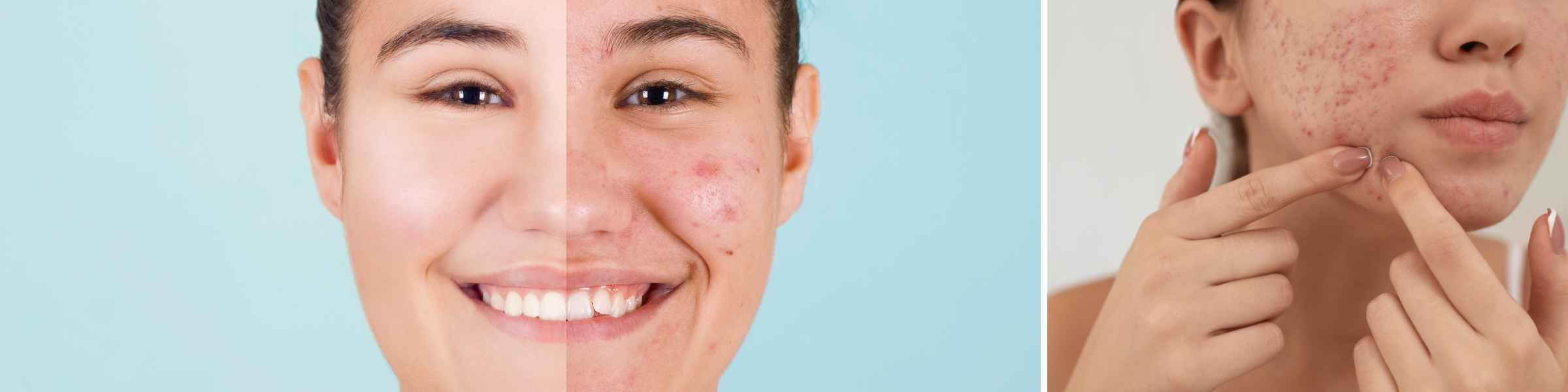 Fight against Acne