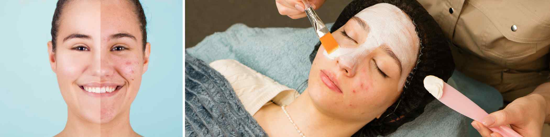 Saffron for Acne Treatment