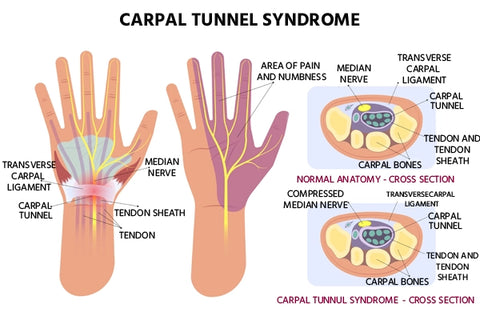 Carpal Tunnel Syndrome diagram