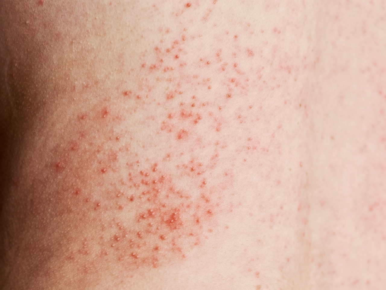 Skin with red rashes and eczema