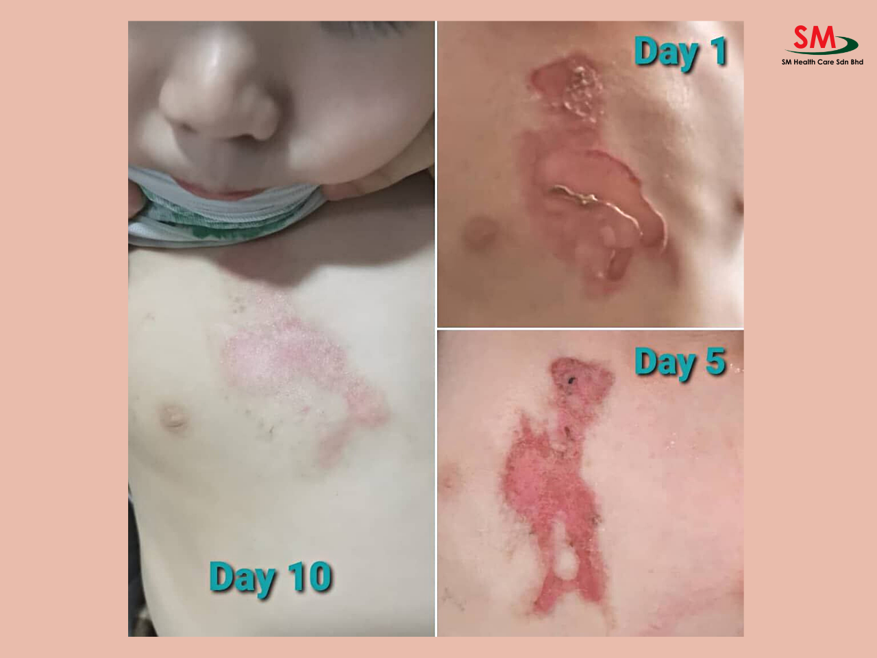 Testimony of Si-Aid used for burn wound - changes from Day 1 to Day 10