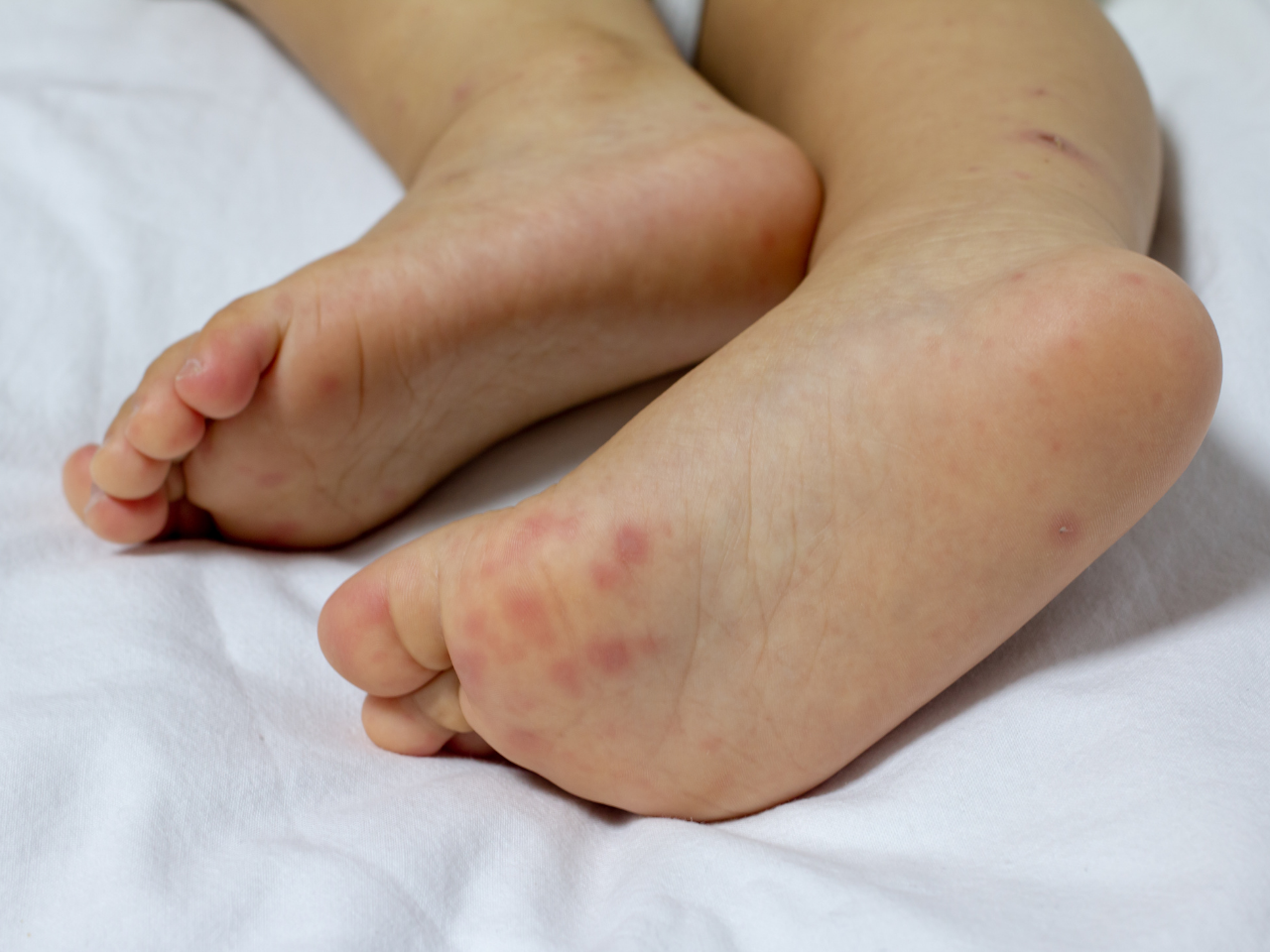 Hand Foot Mouth Disease - feet affected