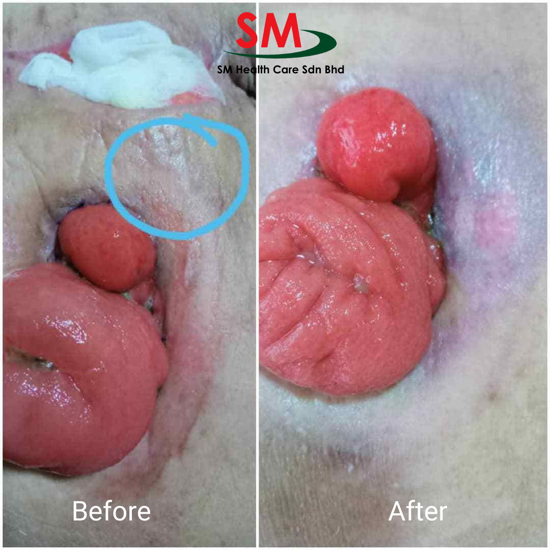 Condition of skin surrounding stoma, before and after