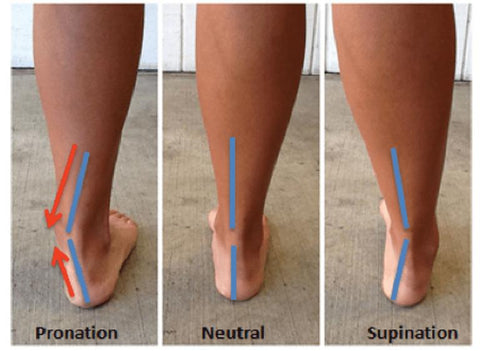 overpronation insoles