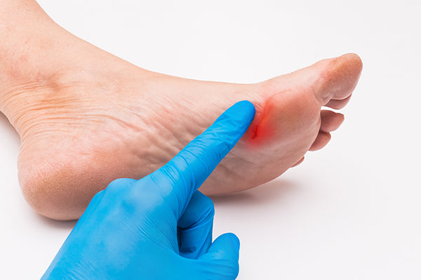 Doctor examining Foot Ulcer