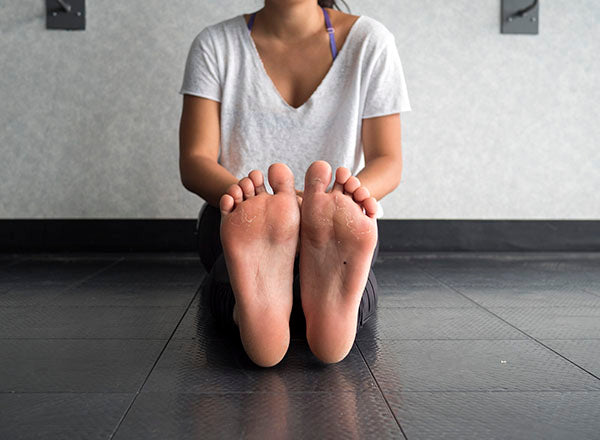 Dancer with calluses on their feet.