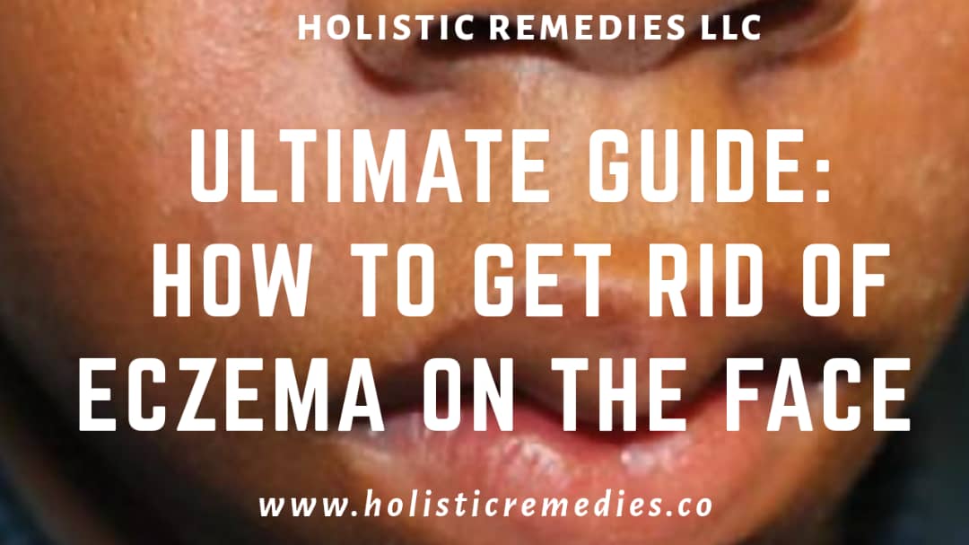 Ultimate Guide How To Get Rid Of Eczema On The Face Infographic Holistic Remedies Llc 9868