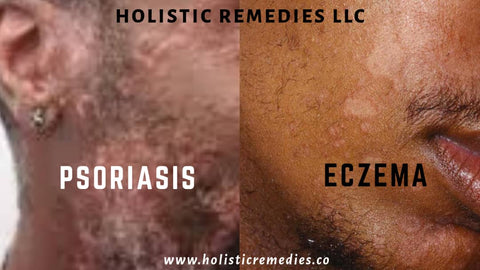 Difference between eczema and psoriasis