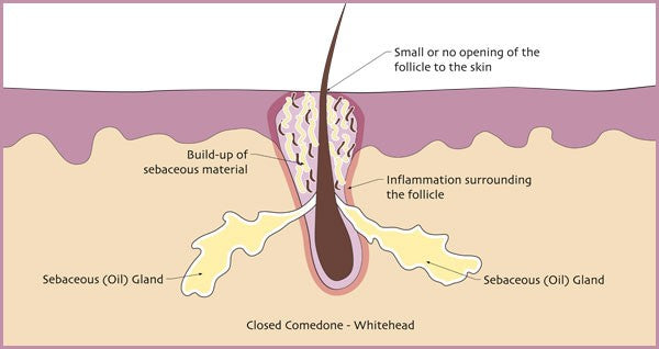 What Are Whiteheads? – Face Reality Skincare back acne diagram 
