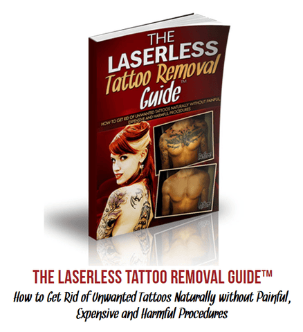 Tattoo Removal