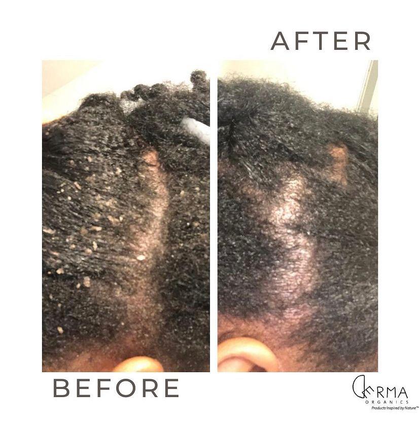 seborrheic dermatitis scalp african american hair