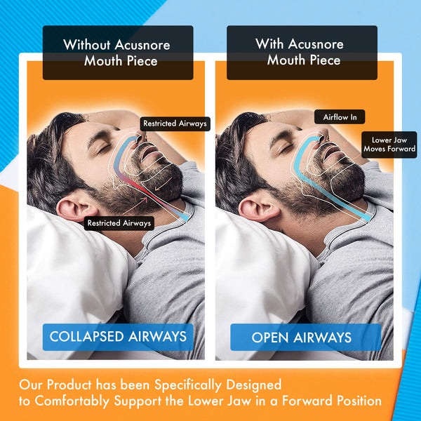Acusnore Anti Snore Mouth Guard - Gum Shield 3