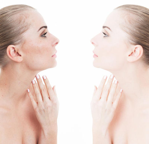 Prevent Acne Collagen Benefits