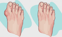 "Comparaison-avant-et-après-l'utilisation-des-sandales-correctrices-Hallux-Valgus-pour-le-soulagement-de-la-douleur-et-la-correction-de-l'alignement-du-pied"