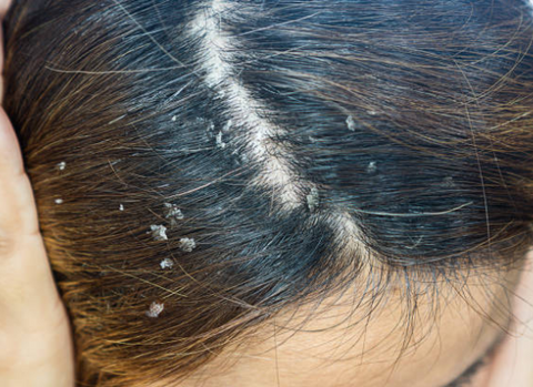 Dry, flaky scalp