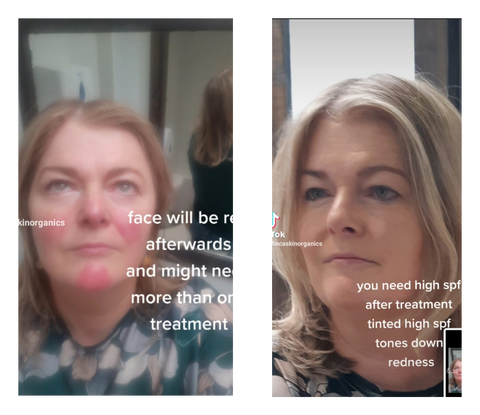 A comparison of before and after treatment using Rosacea Laser Therapy