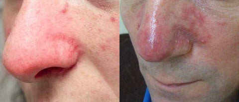 an example of advanced rosacea