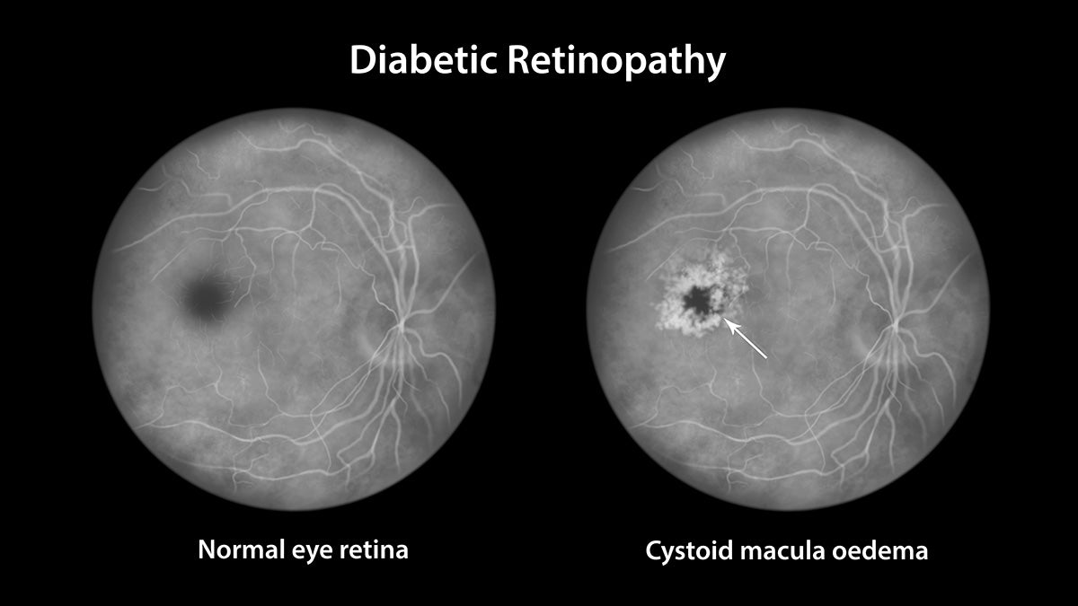 Diabetic retinopathy, diabetic edema