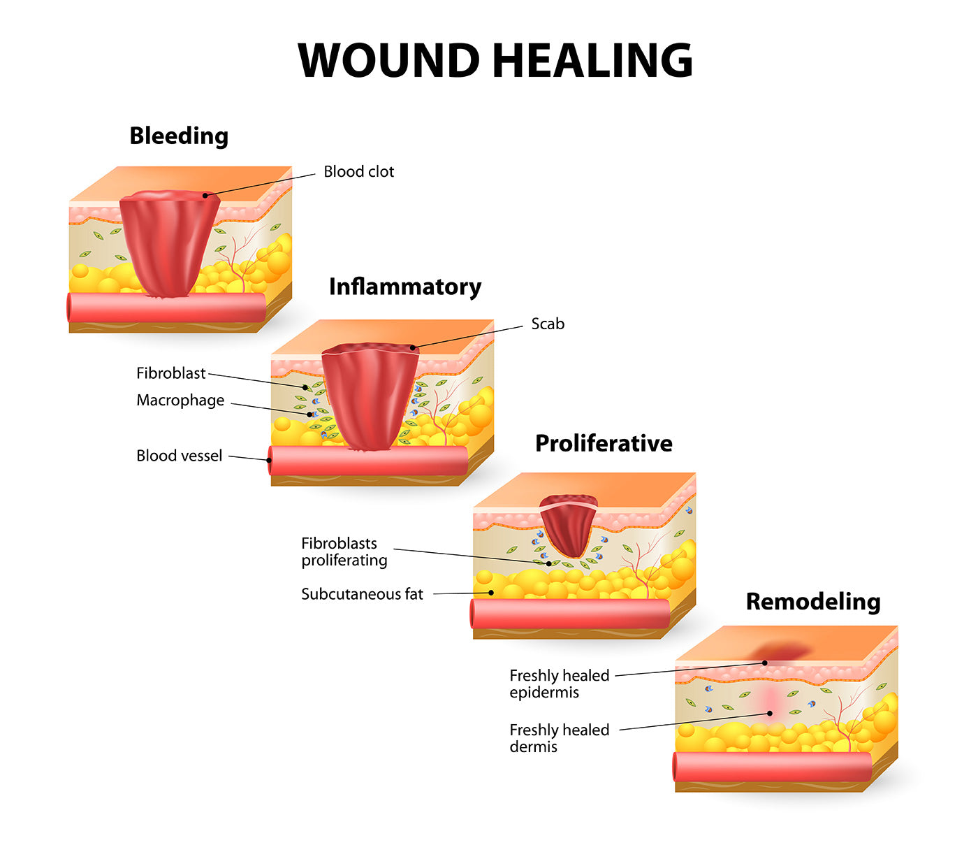 four phases of wound healing