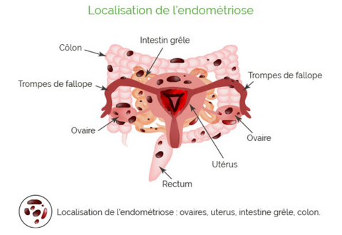 l'endométriose est localisée sur différents organes