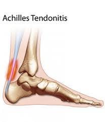 ACHILLES TENDINITIS