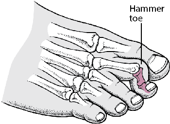 Hammertoe 