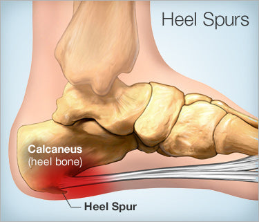 Plantar Fasciitis - Our Complete Guide | Cornerstone Physiotherapy