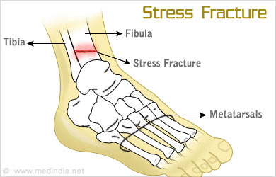 Stress Fractures