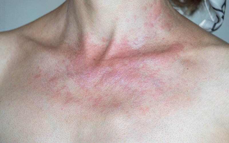 Skin showing a Eczema flare up