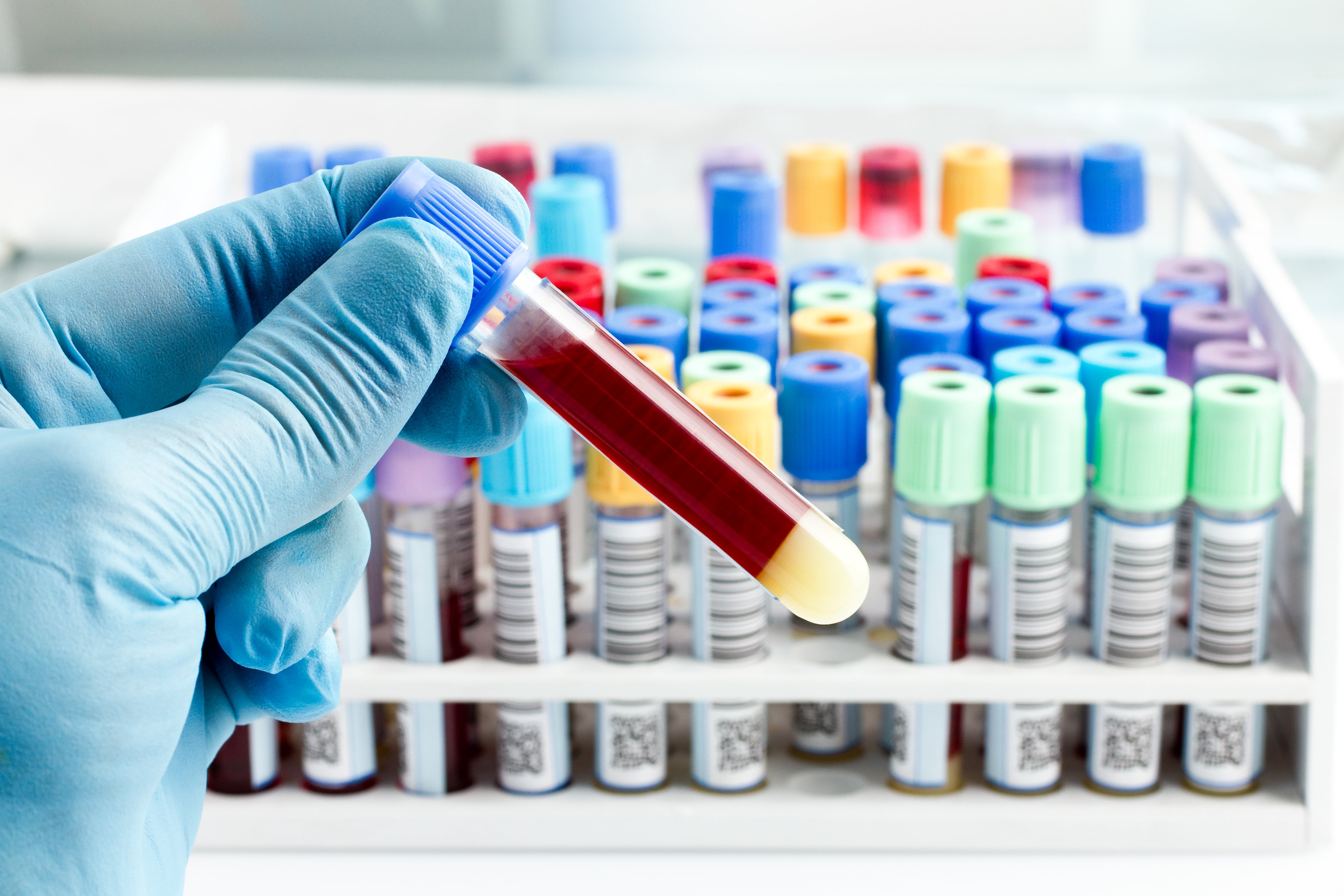 Herpes Simplex Virus 1 & 2 IgG Blood Test