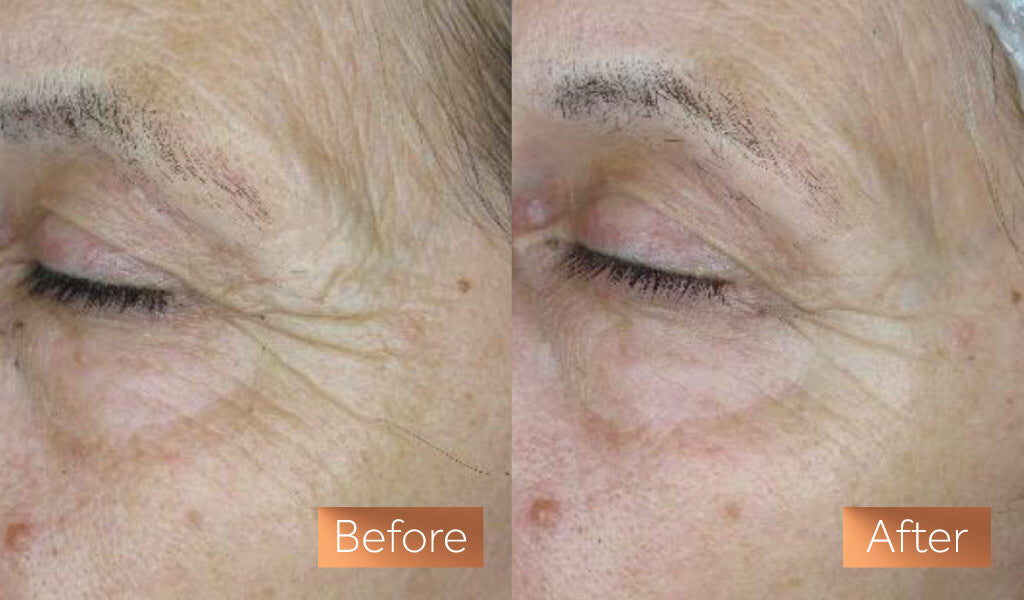 Two photos side by side, the first showing a close up of a white woman's eye and cheek with wrinkles prior to using Maxerum serum, the second showing the same section of her face with reduced wrinkles after using Maxerum