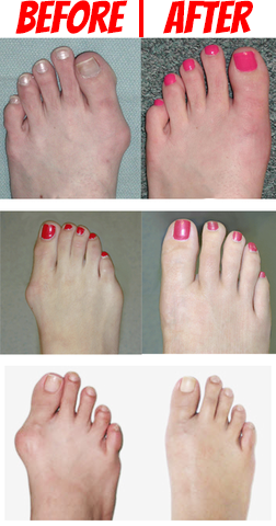 bunions before and after