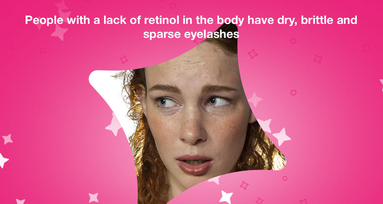 People with a lack of retinol in the body have dry, brittle and sparse eyelashes