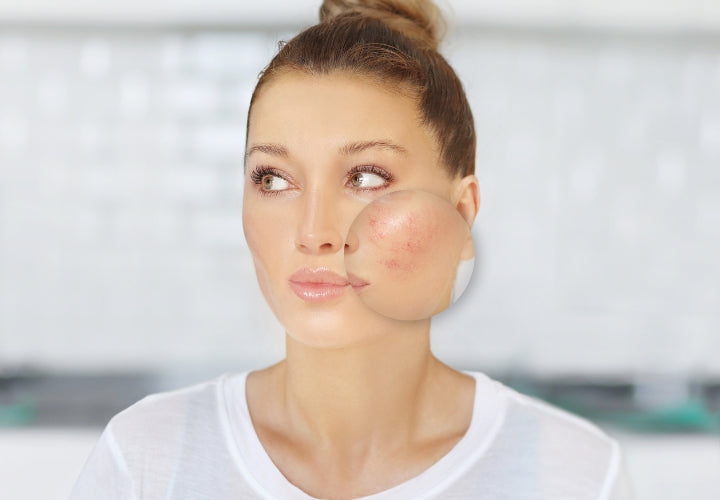 How To Get Rid Of Acne Redness : A Comprehensive Guide – Misumi Luxury 