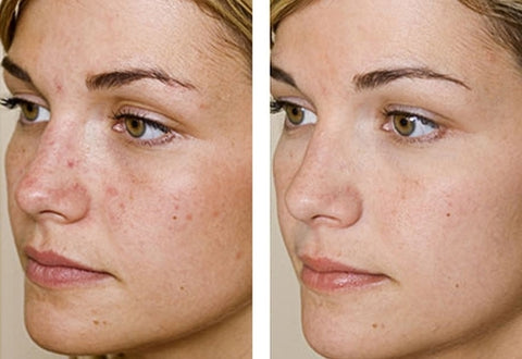 Imagini pentru skin clear before and after